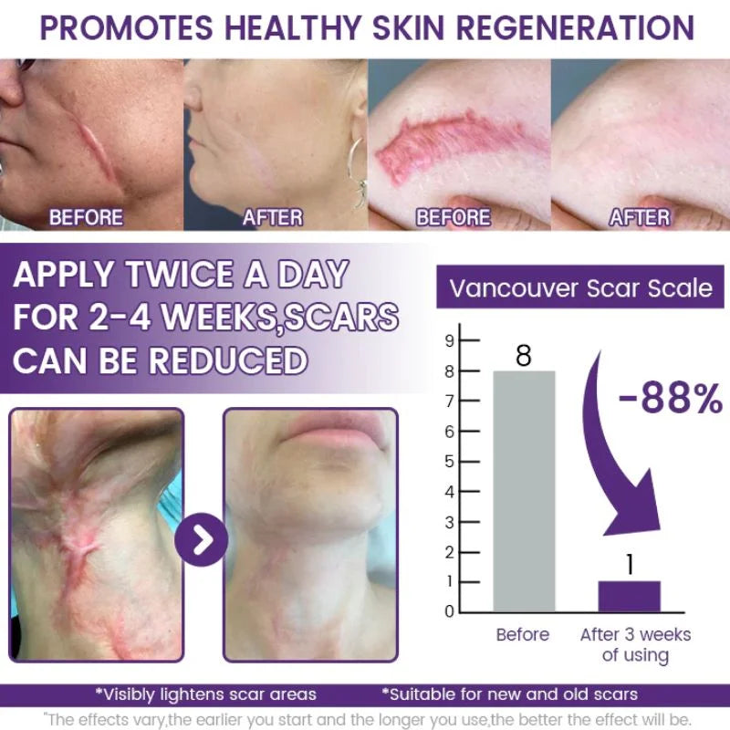 TIMILK Scarvanisher Scar Gel 30g | Advanced Scar & Stretch Marks Removal Cream | Fast-Absorbing Skin Repair Gel